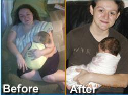 Gastric Bypass Surgery Patient Kathryn and her Successful Pregnancy